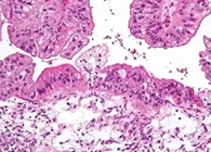 【Science速递】“沉默的杀手”卵巢癌的治疗新靶点终于被发现了