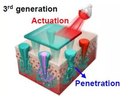 第三代：通过微针介导的皮肤层破坏和微针伴随的各种功能增强药物转运.jpg