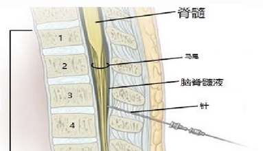 经腰椎穿刺采集脑脊液.jpg